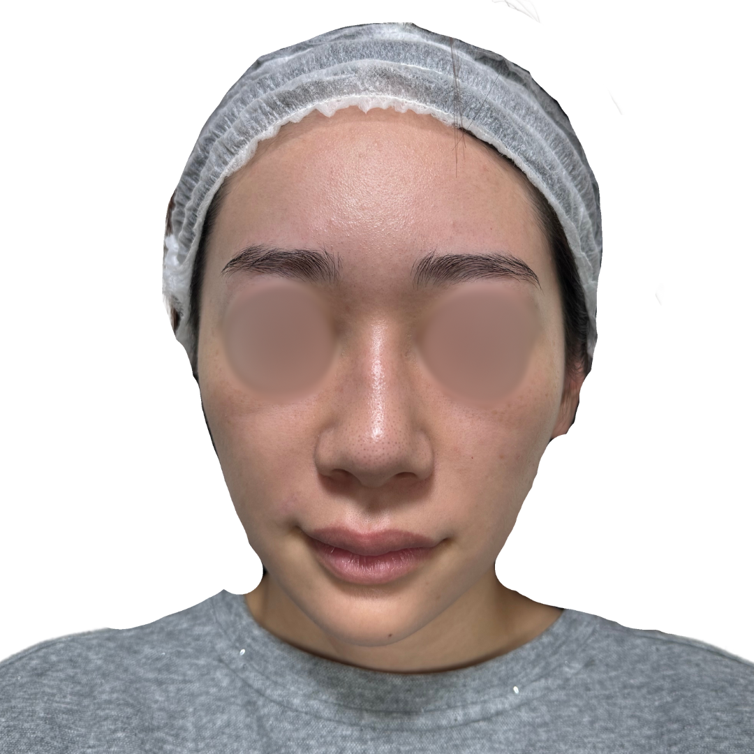 水光注射（スキンブースター）